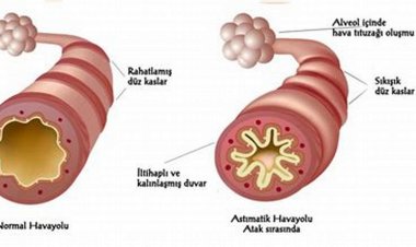 Astım Nedir? Belirtileri ve Tedavisi